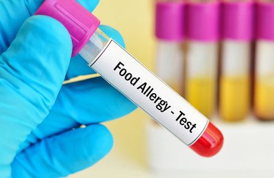 A Comprehensive Guide for Food Allergies Test