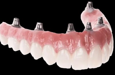 The Process Of Getting Dental Implants
