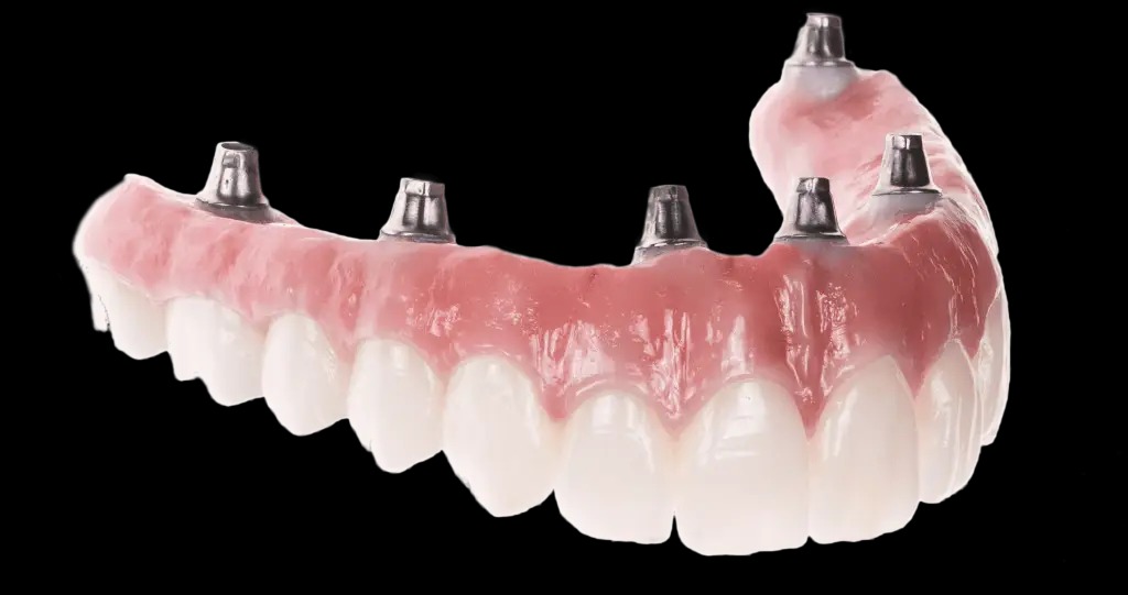The Process Of Getting Dental Implants